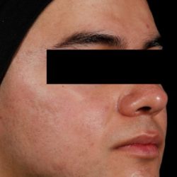 AviClear Before & After Patient #1669